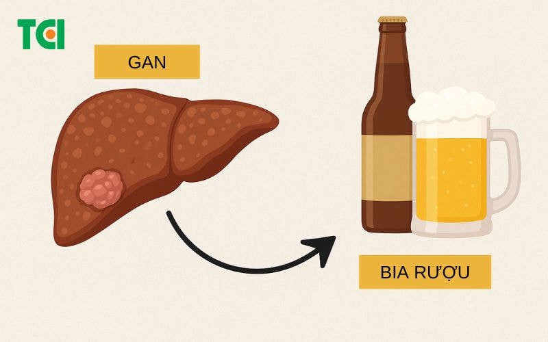 Bệnh gan do rượu là gì?