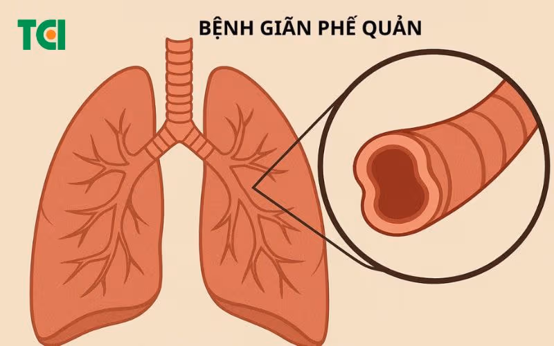 Bệnh giãn phế quản là gì?