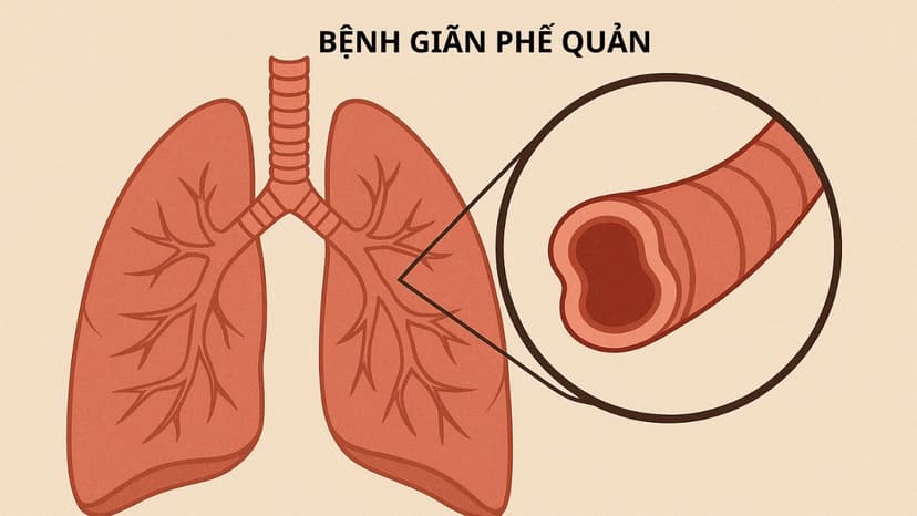 Bệnh giãn phế quản: Những điều bạn chưa biết