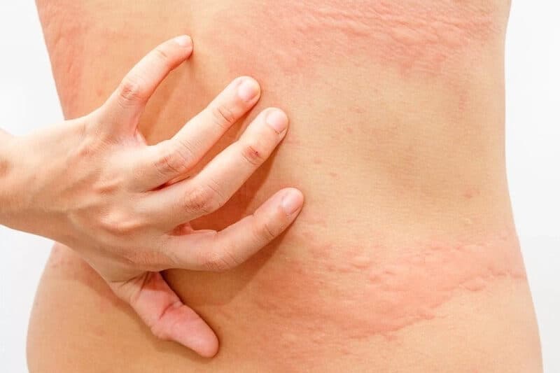 triệu chứng và biểu hiện lâm sàng của bệnh sán lá gan