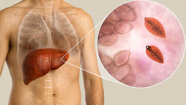 Bệnh sán lá gan ở người: Những điều cần biết để bảo vệ sức khỏe