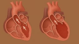 Bệnh thấp tim là gì, biểu hiện và điều trị ra sao?