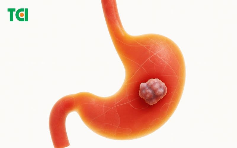 Bệnh ung thư dạ dày là gì?