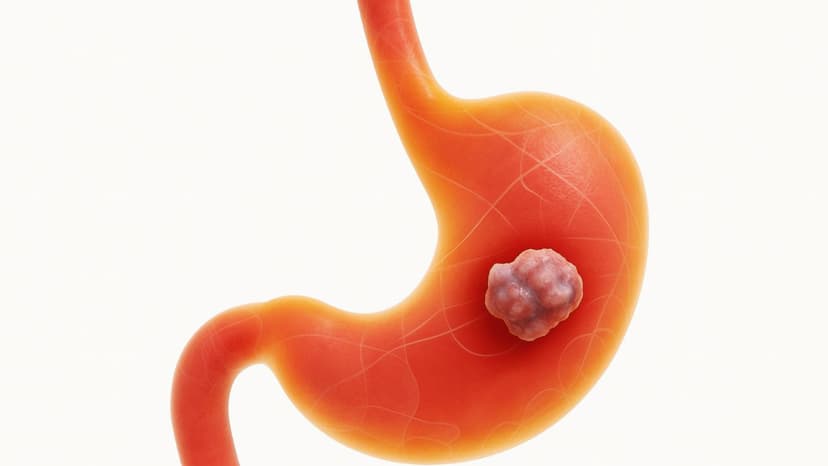 Bệnh ung thư dạ dày là gì? Dấu hiệu sớm và cách điều trị