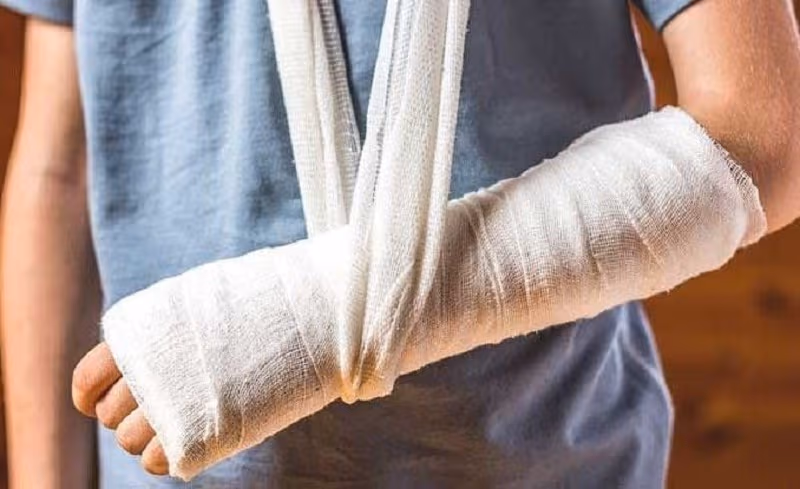 Sơ cứu ban đầu khi nghi gãy xương bao gồm cố định phần tay bị thương