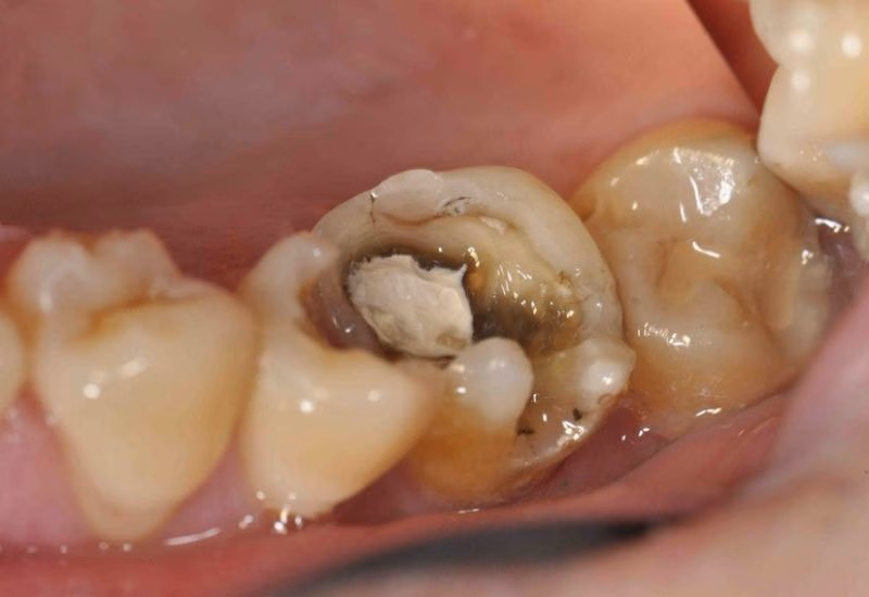 Chữa sâu răng số 7 là điều cần thiết để không gây biến chứng về sau