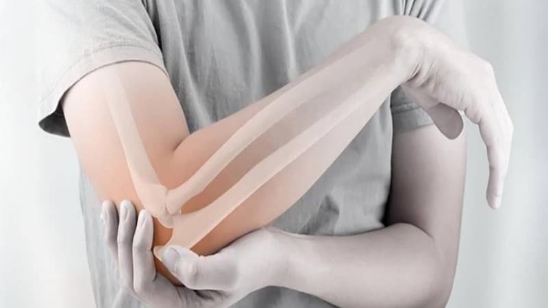 Gãy 1/3 dưới xương cẳng tay là một trong những dạng gãy phổ biến của xương cẳng tay,