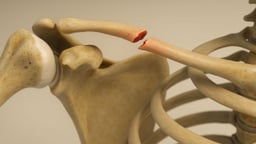 Gãy xương đòn ở trẻ em – Nhận biết, nguyên nhân và điều trị