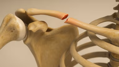 Gãy xương đòn ở trẻ em – Nhận biết, nguyên nhân và điều trị