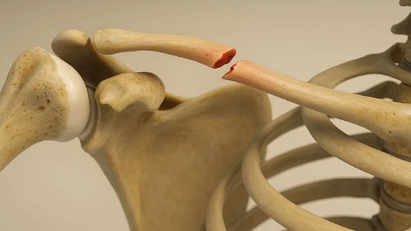 Gãy xương đòn ở trẻ em – Nhận biết, nguyên nhân và điều trị