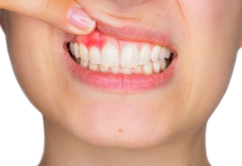 Viêm lợi có ăn được thịt gà không? - Viêm lợi là tình trạng viêm nhiễm xảy ra ở nướu răng, thường do vi khuẩn tích tụ trong mảng bám răng gây ra.