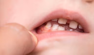 Giải pháp khắc phục hiệu quả cho tình trạng bé bị viêm chân răng