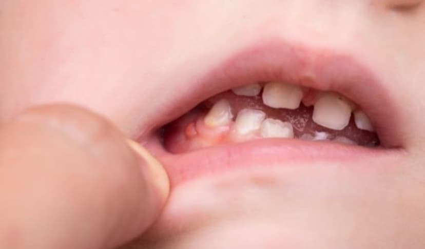 Giải pháp khắc phục hiệu quả cho tình trạng bé bị viêm chân răng