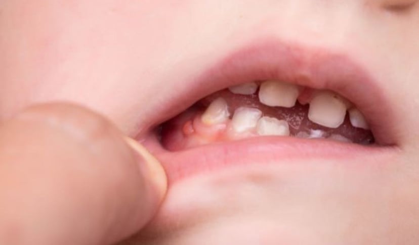 Giải pháp khắc phục hiệu quả cho tình trạng bé bị viêm chân răng