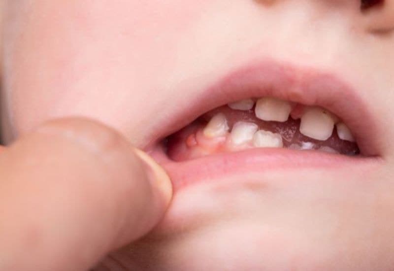 Bé bị viêm chân răng là tình trạng khá phổ biến hiện nay.