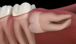 Mọc răng số 8 bị đau: Nguyên nhân và cách giảm đau hiệu quả