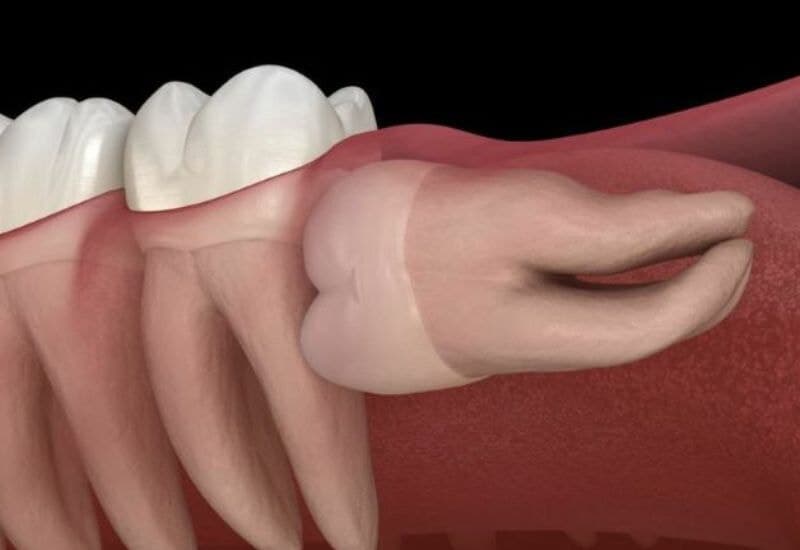Mọc răng số 8 bị đau là tình trạng phổ biến của người trưởng thành hiện nay.