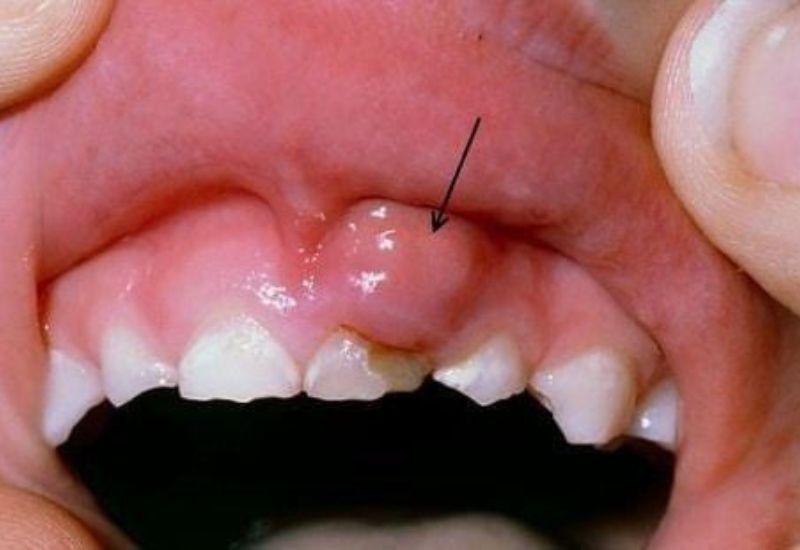 Trẻ 3 tuổi bị viêm lợi là tình trạng khá phổ biến hiện nay.