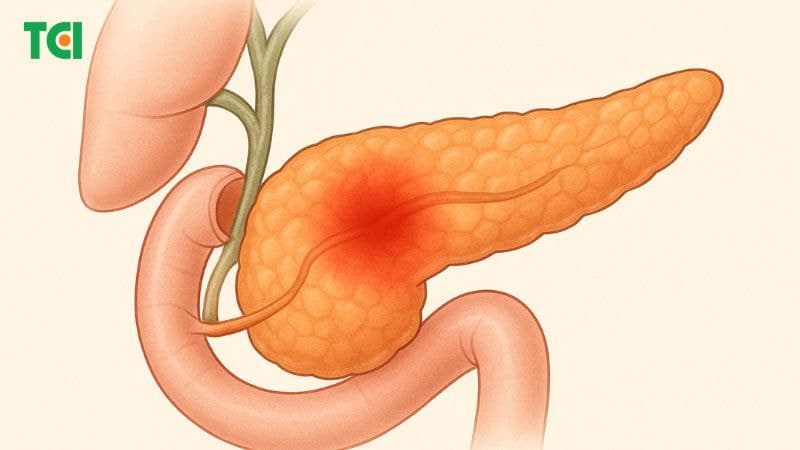 Viêm tụy cấp là một tình trạng y tế nghiêm trọng, đặc trưng bởi sự viêm nhiễm đột ngột của tuyến tụy