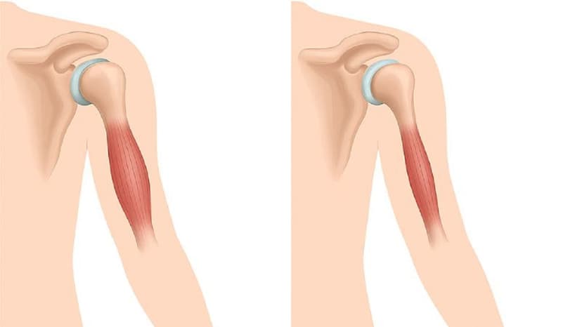 Tìm hiểu chi tiết về tình trạng loạn dưỡng cơ