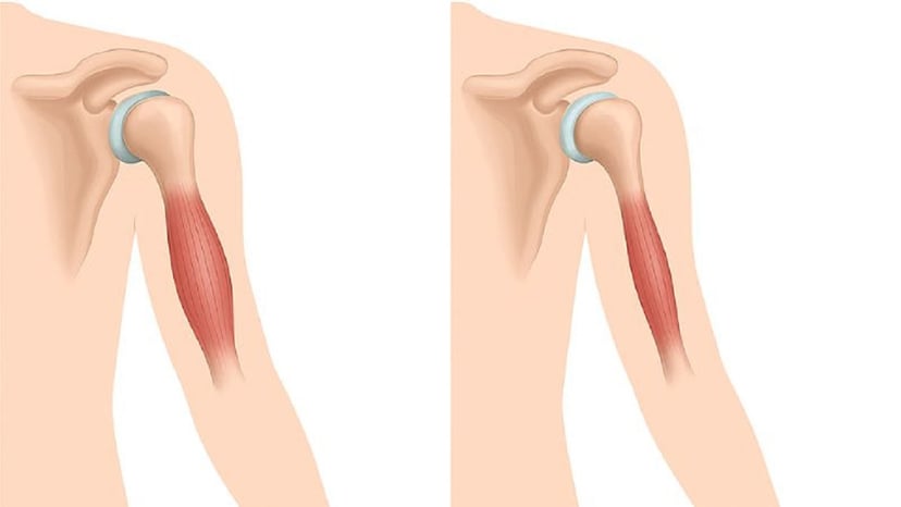 Tìm hiểu chi tiết về tình trạng loạn dưỡng cơ