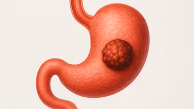 Tìm hiểu nguyên nhân gây ung thư dạ dày từ chuyên gia y tế