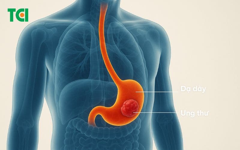 Ung thư dạ dày là gì?