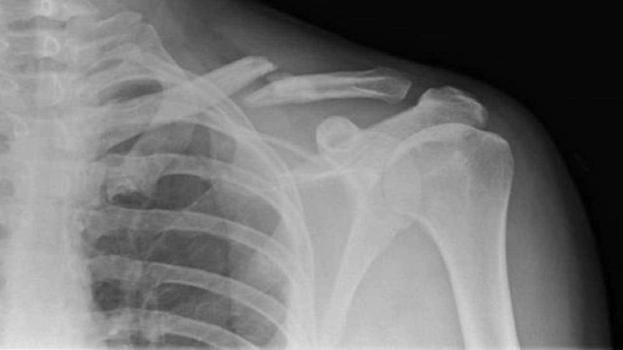 Tư thế nằm ngủ khi bị gãy xương đòn