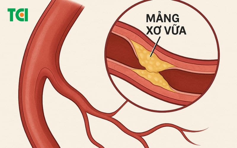 Xơ vữa mạch máu là gì?