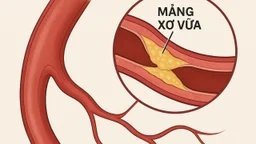 Xơ vữa mạch máu: Nguyên nhân và dấu hiệu nhận biết