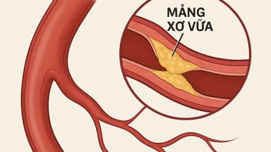 Xơ vữa mạch máu: Nguyên nhân và dấu hiệu nhận biết