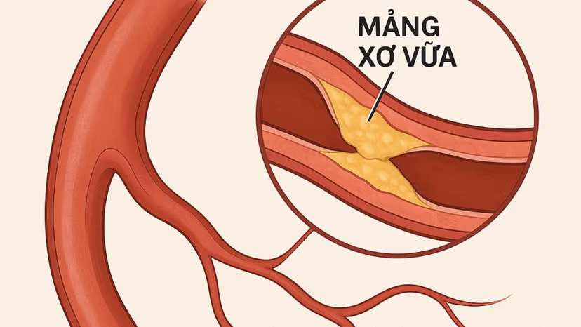 Xơ vữa mạch máu: Nguyên nhân và dấu hiệu nhận biết