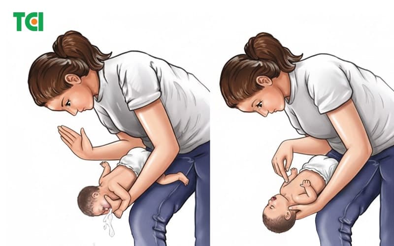 xử trí sặc sữa - thực hiện nhanh chóng và kịp thời