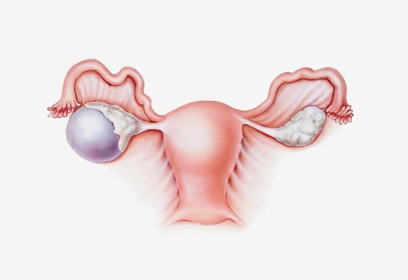 Một số bệnh lý phụ khoa có thể làm bụng to hoặc cảm giác đầy bụng: u nang buồng trứng, u xơ tử cung...