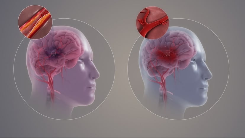 Các dạng tai biến mạch máu não thường gặp