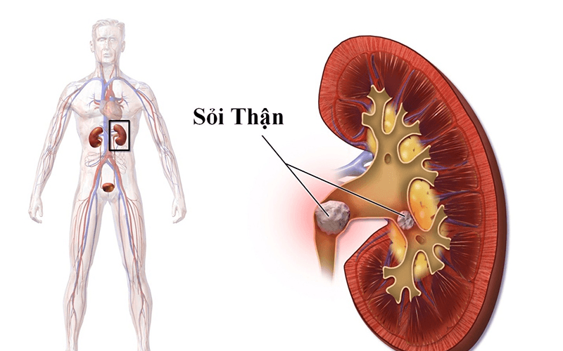 Người có tiền sử sỏi thận, sỏi tiết niệu hoặc đang điều trị sỏi