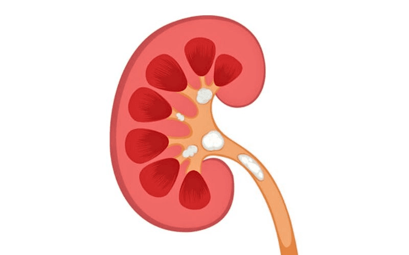 Nhận biết dấu hiệu thận ứ nước, bảo vệ chức năng thận