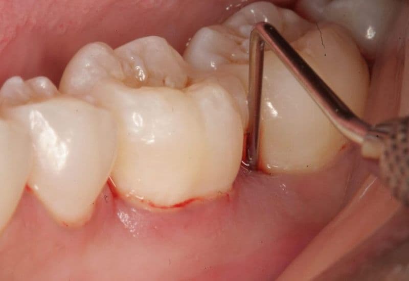 Đau lợi răng khôn là tình trạng nướu quanh răng khôn bị viêm, sưng và đau khi răng mọc hoặc do tác động khác.