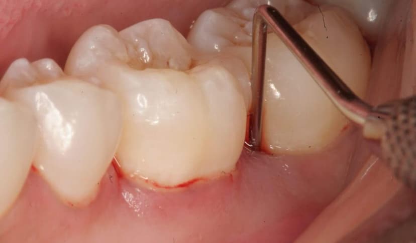 Nguyên nhân và triệu chứng thường gặp khi đau lợi răng khôn