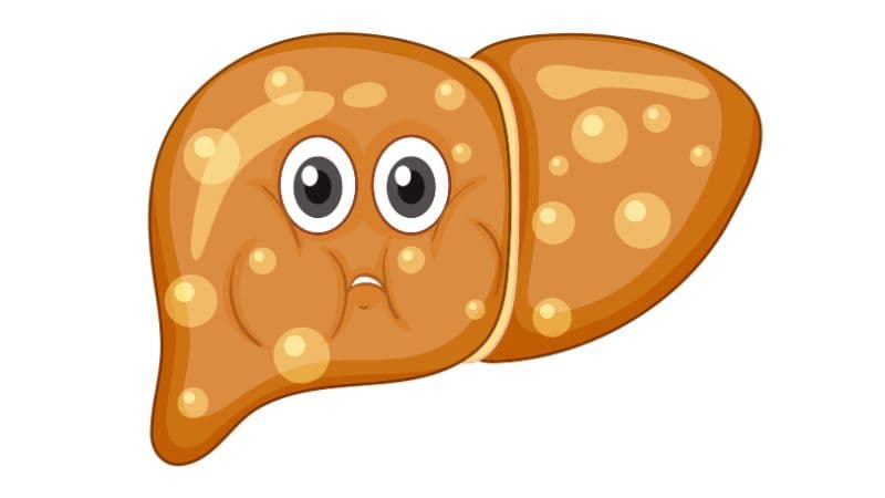 Hiểu về gan nhiễm mỡ độ 2 và chế độ ăn