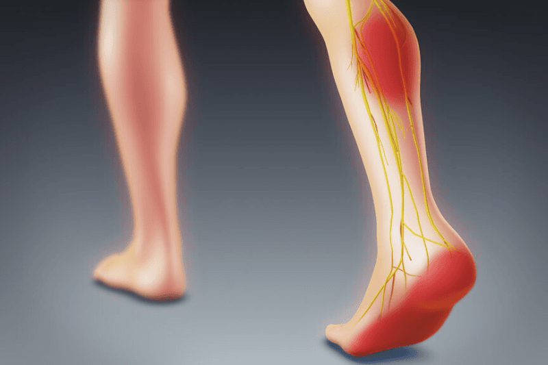 viêm đau dây thần kinh tọa