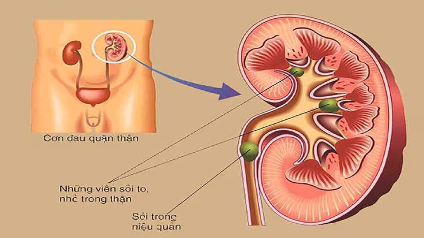 Bị sỏi tiết niệu có nguy hiểm không, phương pháp điều trị hiệu quả