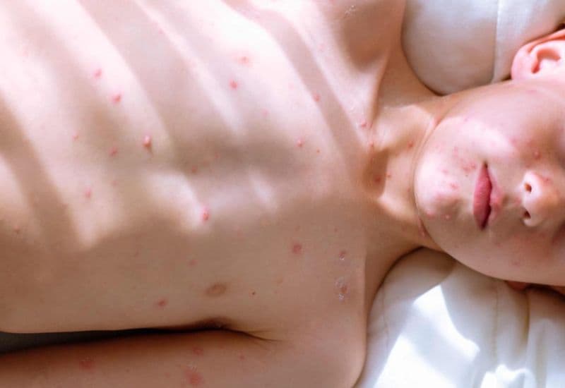 Thủy đậu có kiêng thịt bò không - Hình ảnh người bệnh thủy đậu