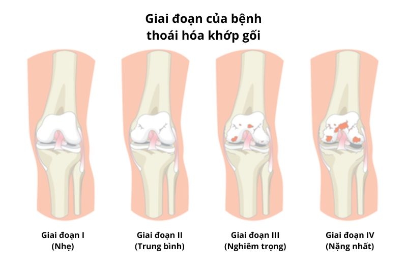 giai đoạn để chẩn đoán thoái hóa khớp gối