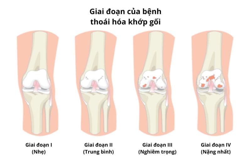 giai đoạn để chẩn đoán thoái hóa khớp gối