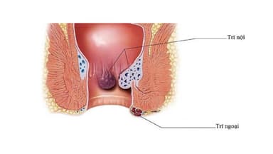 Cẩm nang bệnh trĩ: Trĩ nội và trĩ ngoại khác nhau như thế nào?