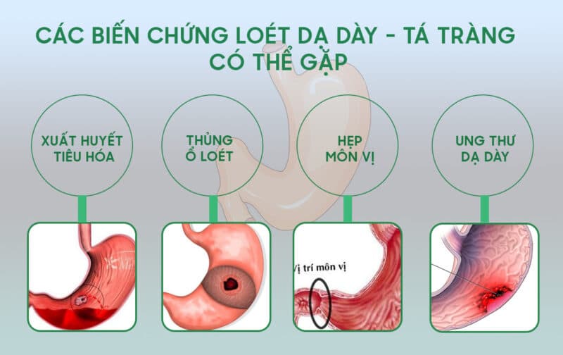 Nhiều biến chứng nghiêm trọng có thể gặp phải nếu không điều trị loét dạ dày kịp thời