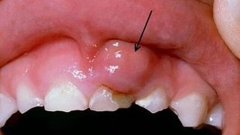 3 Cách trị đẹn nướu răng hiệu quả, an toàn chuẩn y khoa