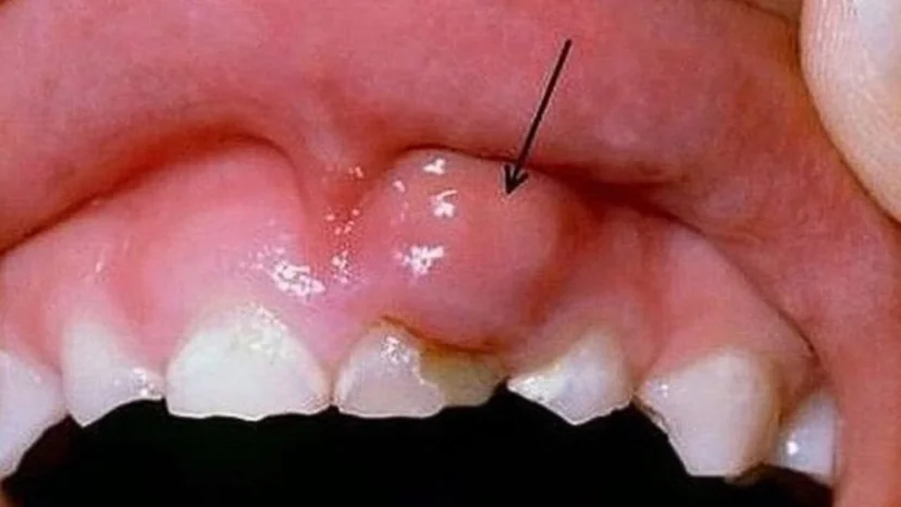 3 Cách trị đẹn nướu răng hiệu quả, an toàn chuẩn y khoa