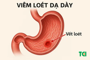 6 Biểu hiện viêm loét dạ dày không thể bỏ qua